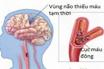 Kết hợp Đông, Tây y điều trị thiểu năng tuần hoàn não 