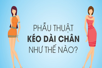 Video: Phẫu thuật kéo dài chân như thế nào?