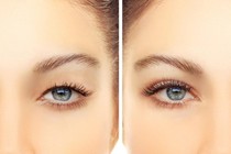 Muốn phẫu thuật mí mắt đẹp, cần chuẩn bị kỹ những việc này