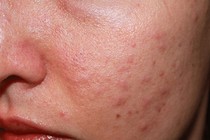 Lý do mụn trứng cá dễ tái phát, khó trị dứt điểm
