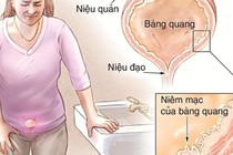 12 bài thuốc hỗ trợ điều trị viêm bàng quang cực hiệu quả