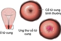 Hơn 12.000 người mắc ung thư cổ tử cung mỗi năm 