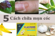 5 cách tốt nhất chữa mụn cóc tại nhà