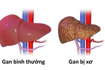 Chuyên gia chỉ điểm 5 kiểu người dễ ung thư gan, bạn có trong số đó?