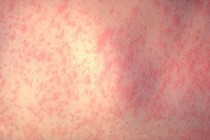 Cả nước thêm 2 ca tử vong liên quan đến sởi trong tuần qua