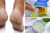 3 cách dùng vaseline trị nứt gót chân không phải ai cũng biết