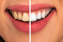 8 cách đơn giản ngừa sâu răng không cần dùng thuốc