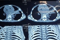 Bé 5 tuổi viêm phổi ròng rã 8 tháng liền: Thủ phạm là que xiên thịt nướng