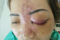 Kinh hoàng những vụ spa không phép tiêm filler gây biến chứng, tàn phế suốt đời