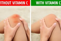 Những dấu hiệu cảnh báo cơ thể đang thiếu hụt vitamin C