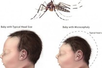 Việt Nam phát hiện ca bệnh do virus Zika, những biến chứng nguy hiểm