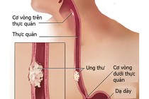 Dấu hiệu dễ thấy của ung thư thực quản