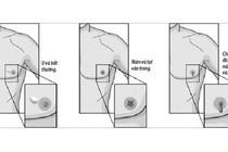 Các dấu hiệu báo động ung thư vú ở nam giới