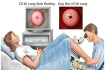 Dấu hiệu nhận biết sớm ung thư cổ tử cung