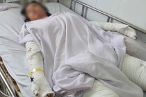 Kiên Giang: Nướng mực bằng cồn, cha mẹ bỏng nặng con gái tử vong