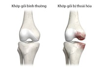Làm gì để cải thiện thoái hóa khớp?