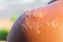 Cách xử lý khi da bị cháy nắng