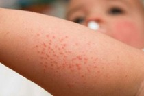 Trẻ con tắm nước lá gì vào mùa hè để trị rôm sảy