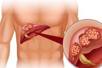 Bí quyết thải độc gan tránh bệnh lý nguy hiểm