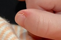 Bé trai bị suy tim phổi vì... cắt xước măng rô