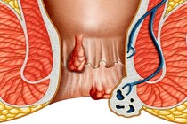 Chuyện ngang trái chồng mắc trĩ khiến vợ bị lãnh cảm