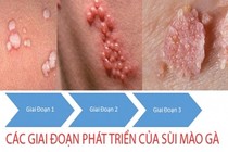 Nhiễm sùi mào gà vì dọn giường nhà nghỉ, lây cho con gái