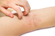 Viêm da tiếp xúc bội nhiễm: Nguyên nhân và cách điều trị