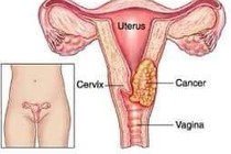 Phụ nữ trẻ muốn sàng lọc ung thư cổ tử cung hãy làm cách này