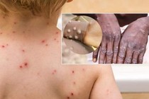 6 đoàn đi kiểm tra, giám sát bệnh đậu mùa khỉ