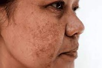 Cách trị vết thâm hiệu quả sau tổn thương da