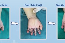 Nghệ An: Tách 4 ngón tay dính liền cho trẻ bị dính bẩm sinh