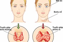 Điều trị bướu cổ Basedow bằng thuốc kháng giáp có an toàn?