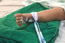 Rắn hổ mèo bò vào nhà nhiều trẻ bị cắn nhiễm độc toàn thân