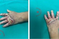 Đắp thuốc nam tay bỏng nước sôi loét hoại tử nặng