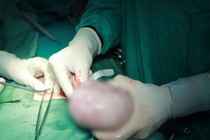 Nữ sinh 17 tuổi bị u nang buồng trứng nguy cơ ác tính cao