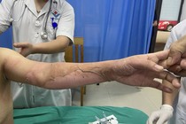 Dùng cồn nướng thức ăn nữ bệnh nhân 26 tuổi bỏng nặng