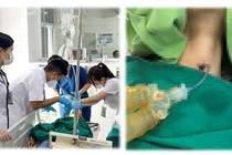 Kẹt tăm bông khi vệ sinh vị trí mở khí quản bệnh nhân nguy kịch
