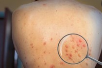 Phát hiện ca đậu mùa khỉ thứ 6, tiết lộ kiểu gen nội địa đầu tiên