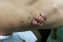 Rối loạn mỡ máu nổi u… dễ gây đột quỵ