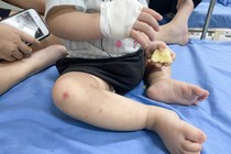 “ Né” bệnh Tay-Chân-Miệng diễn biến nặng thời điểm giao mùa ra sao