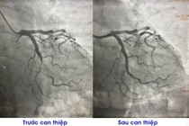 Cùng lúc bị nhồi máu cơ tim và viêm nội tâm mạc nhiễm trùng