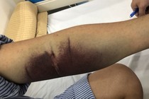 Nhiều người đái tháo đường bị sốt xuất huyết có biến chứng nặng
