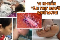 Cứu sống trẻ bị nhiễm vi khuẩn ăn thịt người