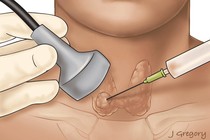 Ngưng thuốc chống đông máu khi chọc tuyến giáp có gây đột quỵ?