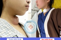 Lấy khối áp xe cổ 14 năm do dị tật khe hở mang cho trẻ