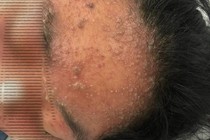 Cô gái 17 tuổi mê sảng, suy đa cơ quan do mắc thủy đậu