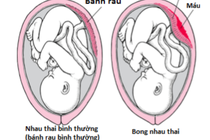 Phát hiện sớm rau bong non, sản phụ vượt cạn bình an