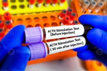 Xét nghiệm phát hiện suy tuyến thượng thận do điều trị Corticoid kéo dài