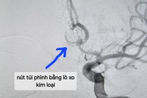 Phình mạch máu não – “Sát thủ thầm lặng” không thể coi thường