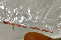 Hy hữu: Xương cá dài 4m trong gan của nam thanh niên